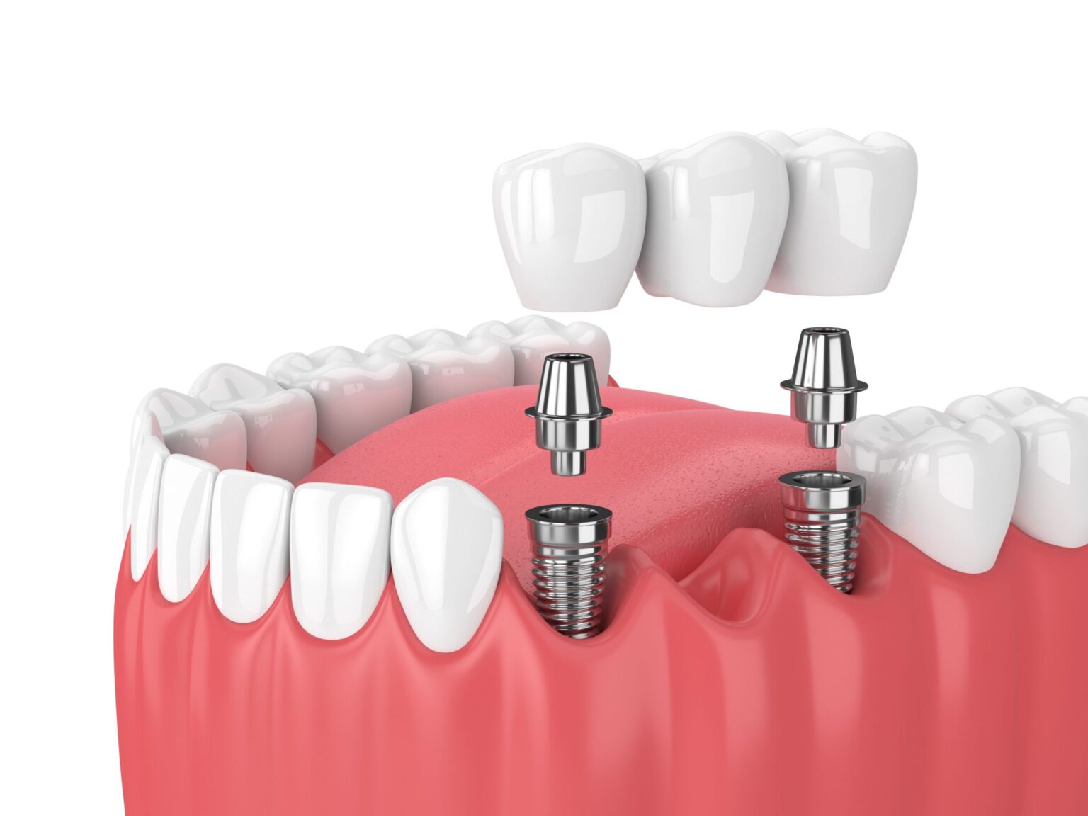 Affordable dental implant near La Porte 77571 TX Dr Kapil
