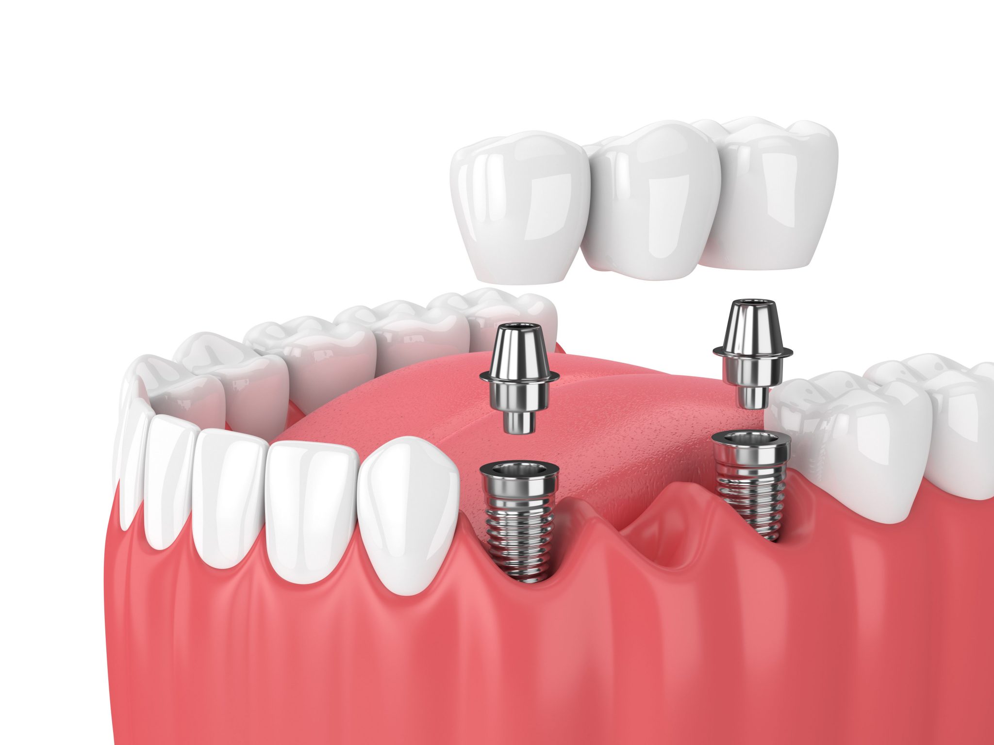 Affordable dental implant near la port tx