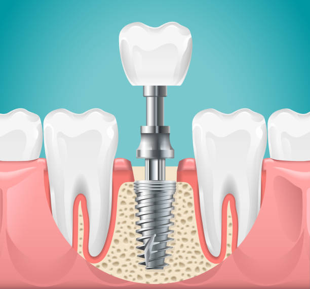 Affordable Dental Implants Near La Porte TX