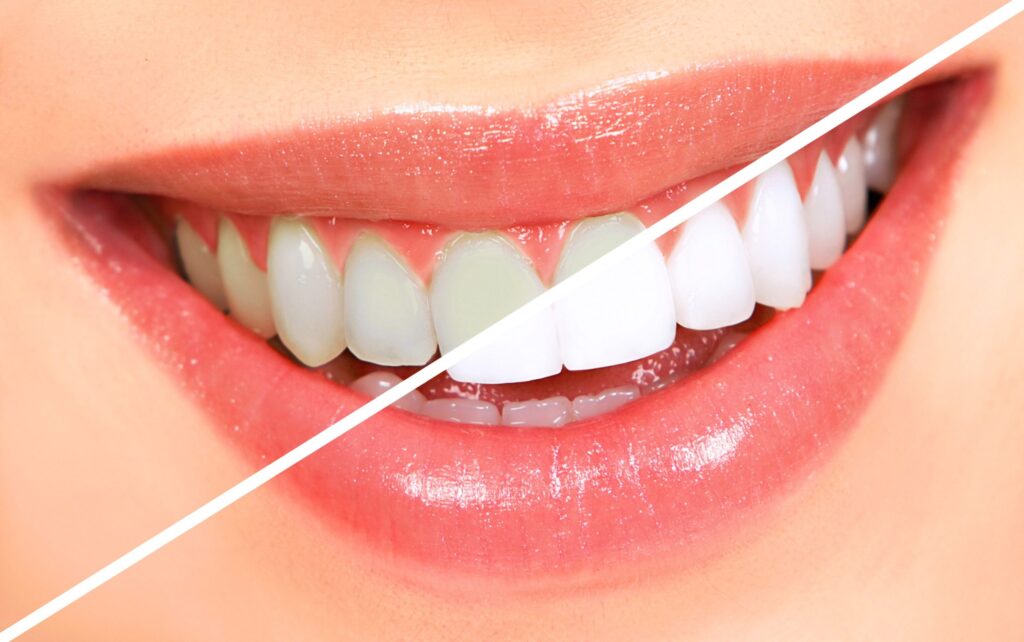 Affordable Teeth Whitening Near La Porte TX 77571 Pristine