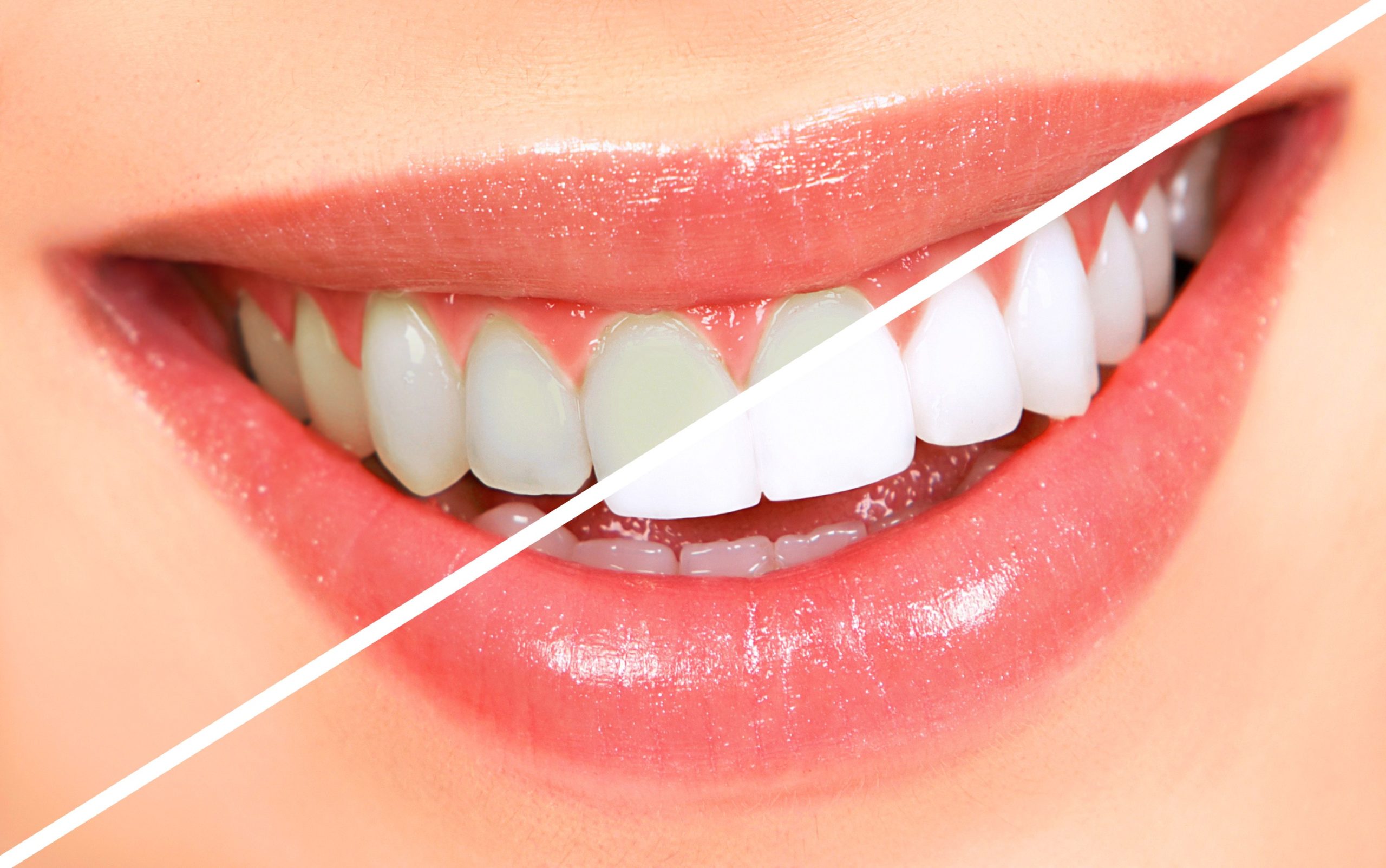 teeth whitening near 77571 | teeth whitening near la porte tx