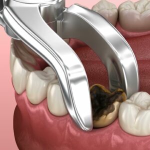 Tooth Extraction Near Texas