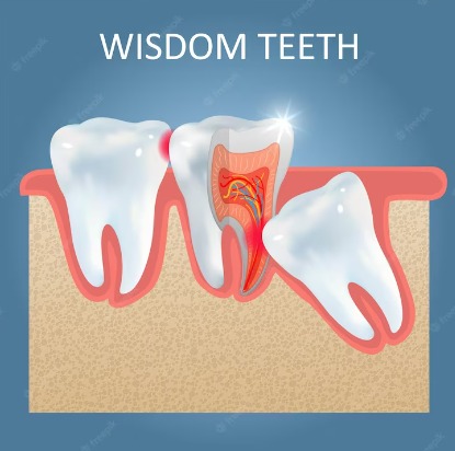 Wisdom Teeth Dentist Near Me